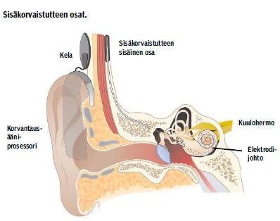 Laitteen säädöt etsitään sopiviksi potilaskohtaisesti (14). Kuva 1. Sisäkorvaistute kuvattuna. Dietz ym. (14). Sisäkorvaistutteen avulla kuuleminen eroaa normaalista kuulosta.