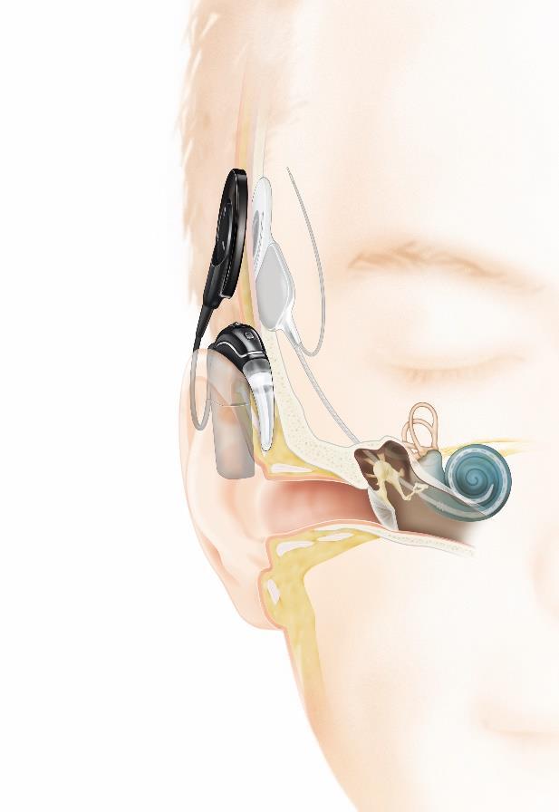 12 Kuva 1. Sisäkorvaistutejärjestelmä. (Cochlear Nordic Ab, 218.