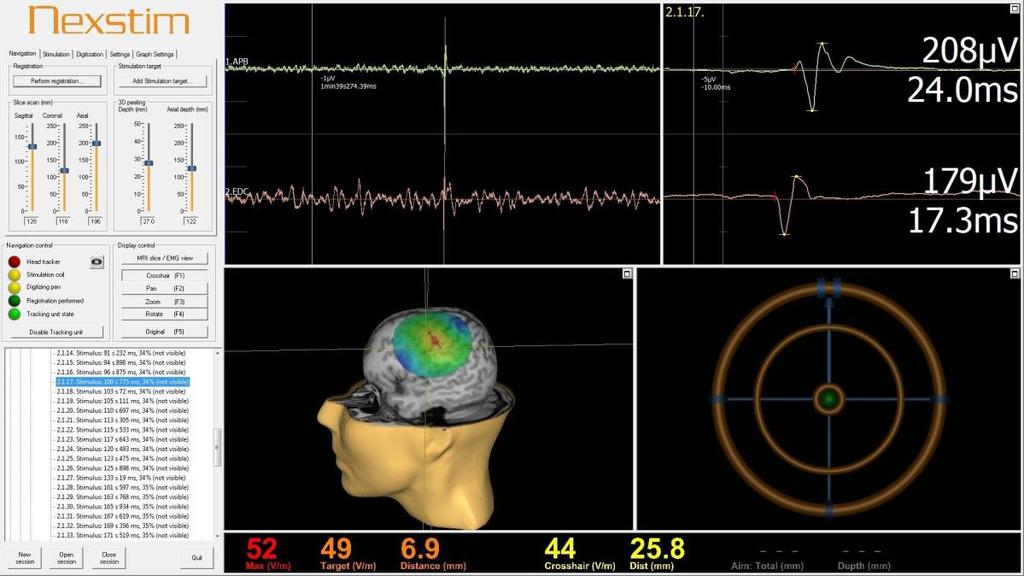 Sähkökenttään perustuva navigointi on Nexstimin TMS:n vahvuus Johtava transkraniaalisen magneettistimulaation teknologia Nexstim TMS -laitteiston käyttöliittymä Nexstimin laite helpottaa erittäin