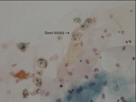 38 Kuva 28. Sieni-itiöitä X500 2.6.6 Muut tulehdukset Myös bakteerivaginoosi (BV) aiheuttaa epänormaalia valkovuotoa ja BV:n aiheuttaa normaalimikrobiston häiriö.