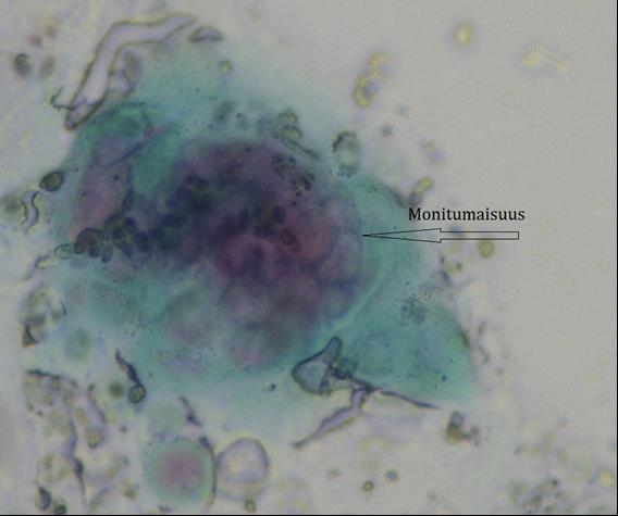41 Kuva 32. Herpes, lakkamarjasolu X1000 Actinomyces eli sädesieni on grampositiivinen sauvabakteeri (Vesterinen, 2004), joka voi aiheuttaa genitaalialueen tulehduksen.