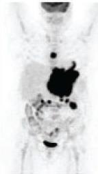 PET/CT syöpätutkimuksissa