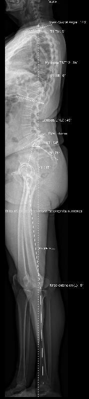 Sagittal vertebral axis SVA Normaali 0,5 cm (±2,5 cm) Nuoret