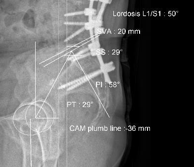 Lantion kallistuskulma PT vs acetabulumin anteversio Lantion kallistuskulman lisääntyessä acetabulumin anteversio lisääntyy Lantion kallistuskulman pienentyessä acetabulumin anteversio pienenee