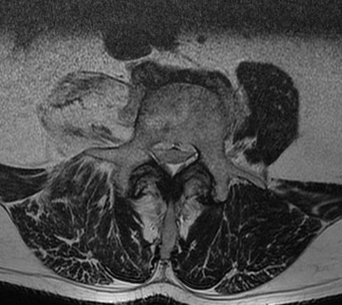 Simple Hip-Spine syndrome Kivun lähde on osoitettavissa lonkkaan tai selkään Gluteuslihaksia hermottavat juuret L5-S2 Positiivinen Trendelenburg vs totaali L5- juurivaurio Piriformis-syndrooma on