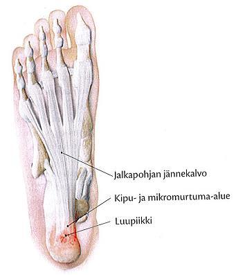 13 Plantaarifaskiitti, jalkapohjan jännekalvon tulehdus on jalkapohjan lihasten kiinnityskohdassa ilmenevä jänteen tulehdustila (kuva 2) (Kauranen 2017, 250).