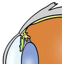 Mikä on Glaukooma? Glaukooma on silmäsairaus, joka vahingoittaa näköhermoa.