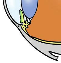 glaukooma voi ilmetä ilman, että silmänpaine on koholla.