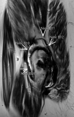 osteolyysi MRI: