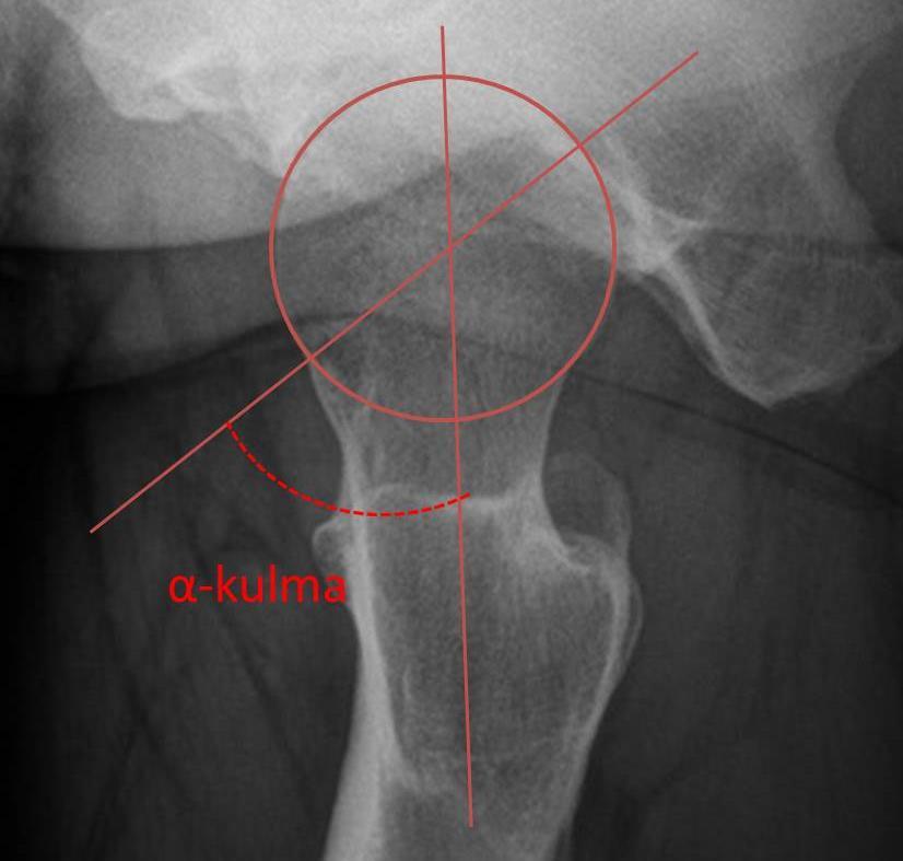 Alfakulma Mittaus läpiammutusta, cross table lateral tai Lauensteinin projektiosta tai MRI collumviistoaksiaalileikkeistä Collumin suuntainen viiva vs.