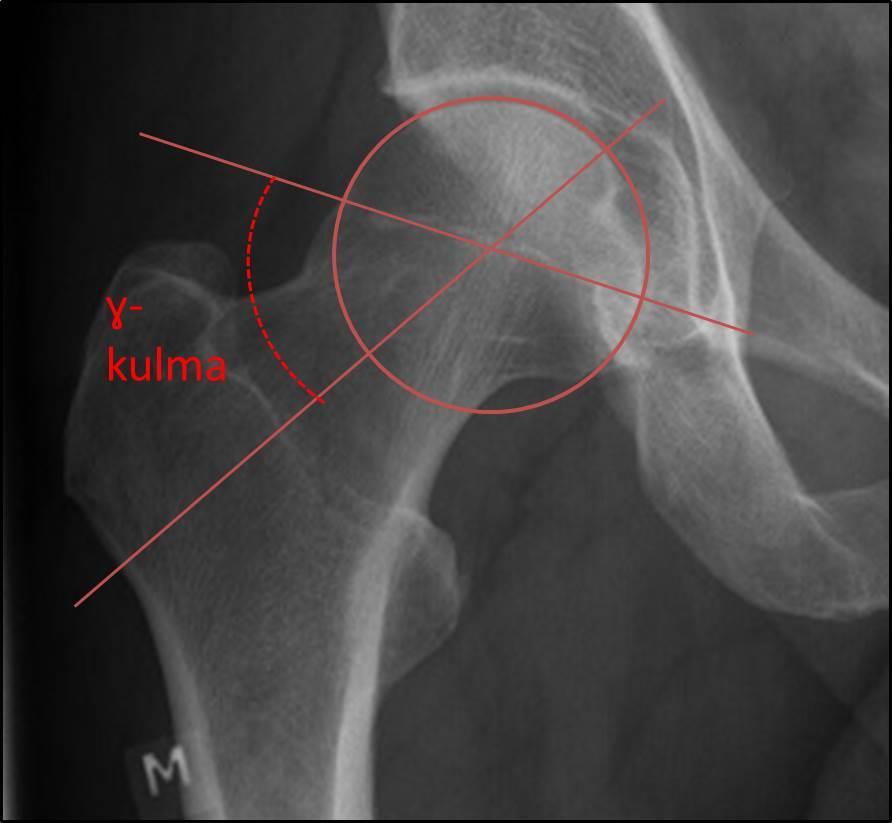 Gammakulma Mittaus lantion AP-kuvasta Femurin collumin suuntainen viiva vs.