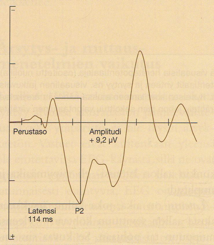 Vasteesta voidaan mitata kunkin aallon latenssi ja amplitudi (kuvio 4). Latenssi tarkoittaa viivettä eli ärsykkeen alusta vasteen alkuun tai huippuun kuluvaa aikaa.