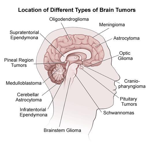 Clinical, molecular genetic and translational research on brain tumors 800-1000 new brain tumors/year in Finland Tampere brain tumor research (Fresh) tumor tissue collection comprised of brain tumor