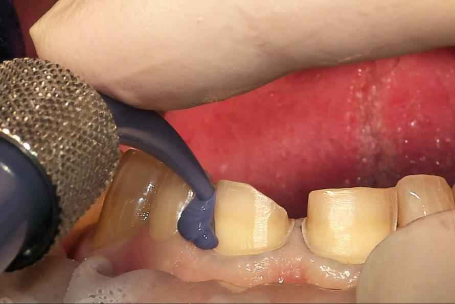 Tavoite Jäljentämällä välitetään informaatio suun tilanteesta hammasteknikolle