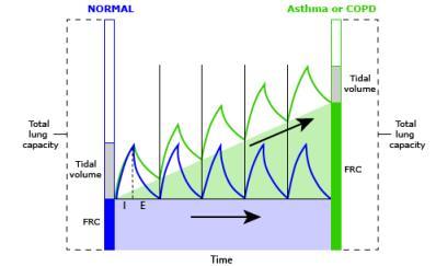 COPD ja yleisanestesia Puudutukset YA Jos voimakas dyspnea, levottomuus, mahdotonta maata selällään, jatkuva yskä Bronkospasmi Respiraattorisäädöt Matalat kertahengitystilavuudet 5-8