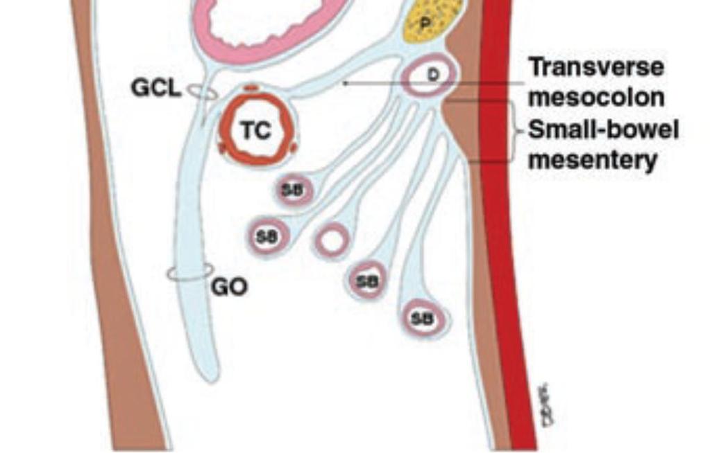 well-defined lesser sac and gastrocolic ligament.