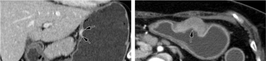 Figure 1. Stage T1 T4 gastric tumors.