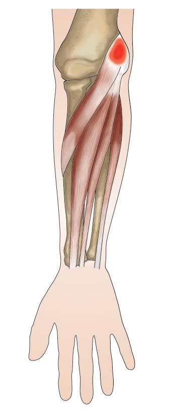 13 Soeur L, Desmoineaux P, Devillier A, Pujol N, Beaufils P. Outcomes of arthroscopic lateral epicondylitis release: Should we treat earlier? Orthop Traumatol Surg Res 2016;102:775 80.