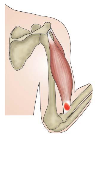 Kuva 3. Hauiksen distaalipään insertiotendiniitti 25 Anzel SH, Covey KW, Weiner AD. Disruption of muscles and tendons. An analysis of 1014 cases. Surgery 1959;45:406 14. 26 Foulk DM, Galloway MT.