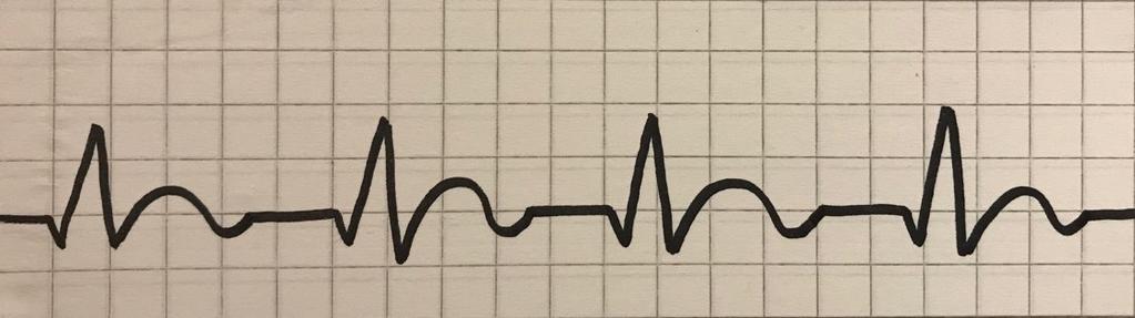 Alkurytmeistä kammiotakykardia ja kammiovärinä ovat defibrilloitavia eli defibrillaattorin