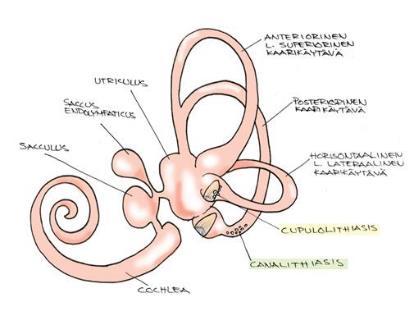 12 3.1 Asentohuimauksen synty Hyvänlaatuisen asentohuimauksen syntyyn on kaksi teoriaa, jossa otoliitit irtoavat utriculuksesta tai sacculuksesta päätyen kaarikäytäviin.