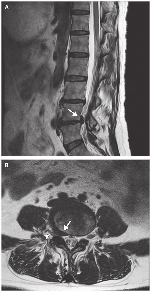 Fig. 4. Sagittal (A) and axial (B) T2-weighted MRI scans of lumbar disc herniation at L4-5.