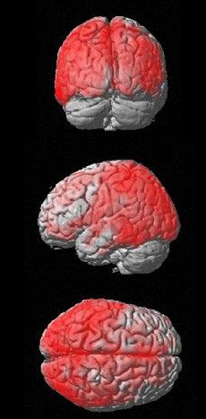 AChE activity was measured with PET using 11 C-MP4A. The subjects with TBI and controls did not differ from each other with regard to either gender or age.
