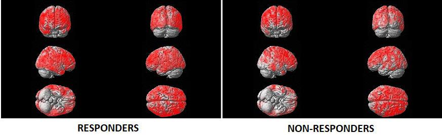 Results analyses showed that in the responders, rivastigmine induced the most marked reduction in AChE activity in the anterior cingulate (-10.2 %, p = 0.021), lateral temporal (-11.6 %, p = 0.