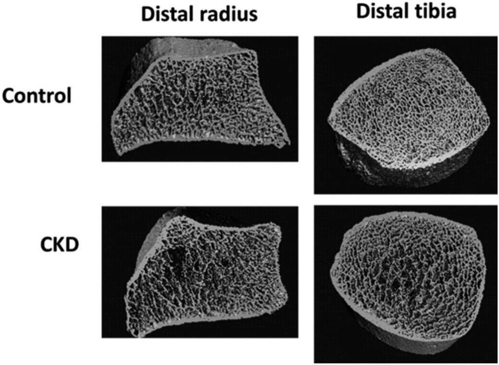 High-resolution peripheral quantitative computed tomography (HR-pQCT) pystyy erottamaan mikroarkkitehtonisia muutoksia sekä kortikaalisessa että trabekulaarisessa luussa