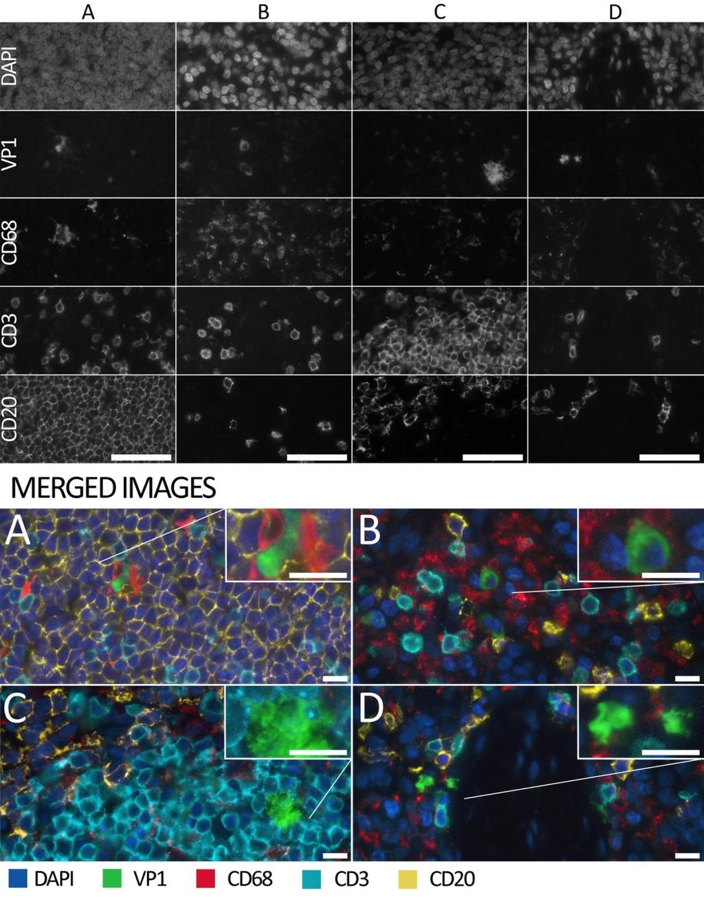 The staining intensity for both CD3 and CD68 -signals colocalizing with the VP1 positive