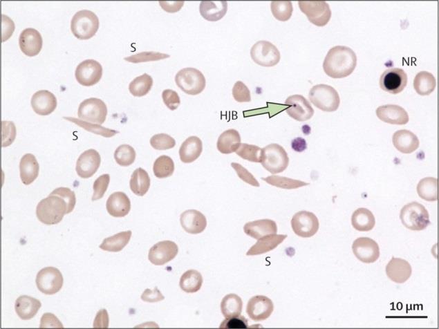 taen oksidatiivista stressiä punasolulle. Sirppisoluanemia aiheutuu β S -alleelin homotsygotiasta. Kuva 8. Sirppisoluanemiaa sairastavan henkilön solunäyte.