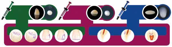 PLT-kapselit 20 x 0,2 g Estelite Universal Flow High ruisku 1,8 ml/3 g + 10 kpl 13825 A1 13829 OPA2 13826 A2 13830 OPA3 13827 A3 13831 OPA4 13828 A3,5 Ruisku 1 ml/1,7 g + 6 kpl 25 e Ruisku 1,8 ml/3 g