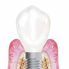 max CAD Cerec (5kpl pak.