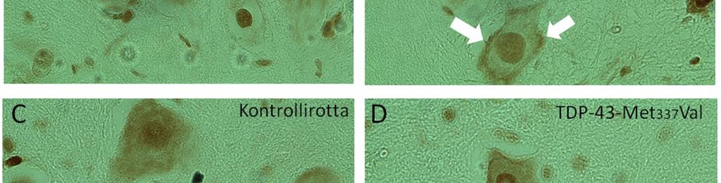 B ja D) Myös TDP-43-Met337Val-rotilla TIA-1 lokalisoituu tumaan enemmän kuin solulimaan.
