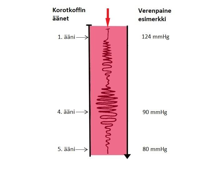 34 nike vapautetaan, laskee mansetin paine nopeudella 3 mmhg sekunnissa. Puoliautomaattisessa mittauksessa kuunnellaan stetoskoopilla Korotkoffin äänet, kuten manuaalisessakin mittaustavassa.