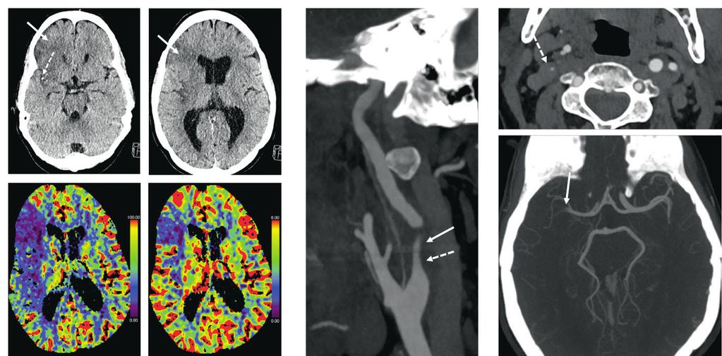 TEEM: IVOINFRKTI E F G D KUV 6. Pään TT-kuvissa (keltaiset nuolet kuvissa ja ) noin vuorokausi oireen alusta näkyy infarktiin sopivaa harventumaa oikealla keskimmäisen aivovaltimon suonitusalueella.