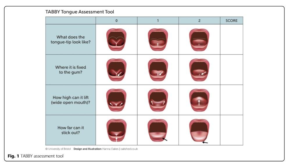 TABBY: Tongue-tie And Breastfed Babies assessment tool The development and evaluation of a picture