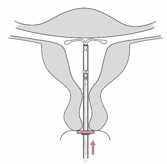 6 5. Pidä asetinta hyvin paikallaan ja avaa Jaydessvalmisteen vaakasakarat vetämällä luistia merkkiin saakka (kuva 5).