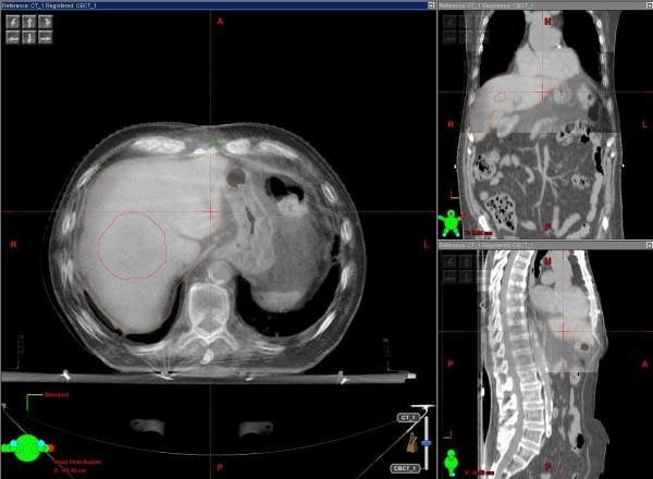 Hoidon toteutus Aina kuvantaohjatusti (CBCT) Maksa liike luihin nähden jopa 1cm fraktiosta toiseen Tuumorin /