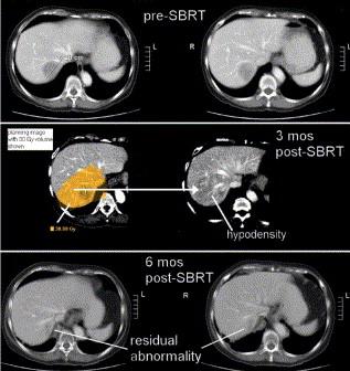 Radiologinen hoitovaste Vasteen arviointi haasteellista maksan sädereaktion vuoksi 2-3kk hoidon jälkeen CT:ssä hypodensisiä muutoksia ulottuen 30-50% isodooseihin Alue laajempi kuin tuumori ennen