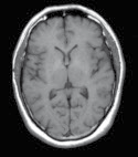 Kuva 5a: Magneettikuva terveen ihmisen aivoista.