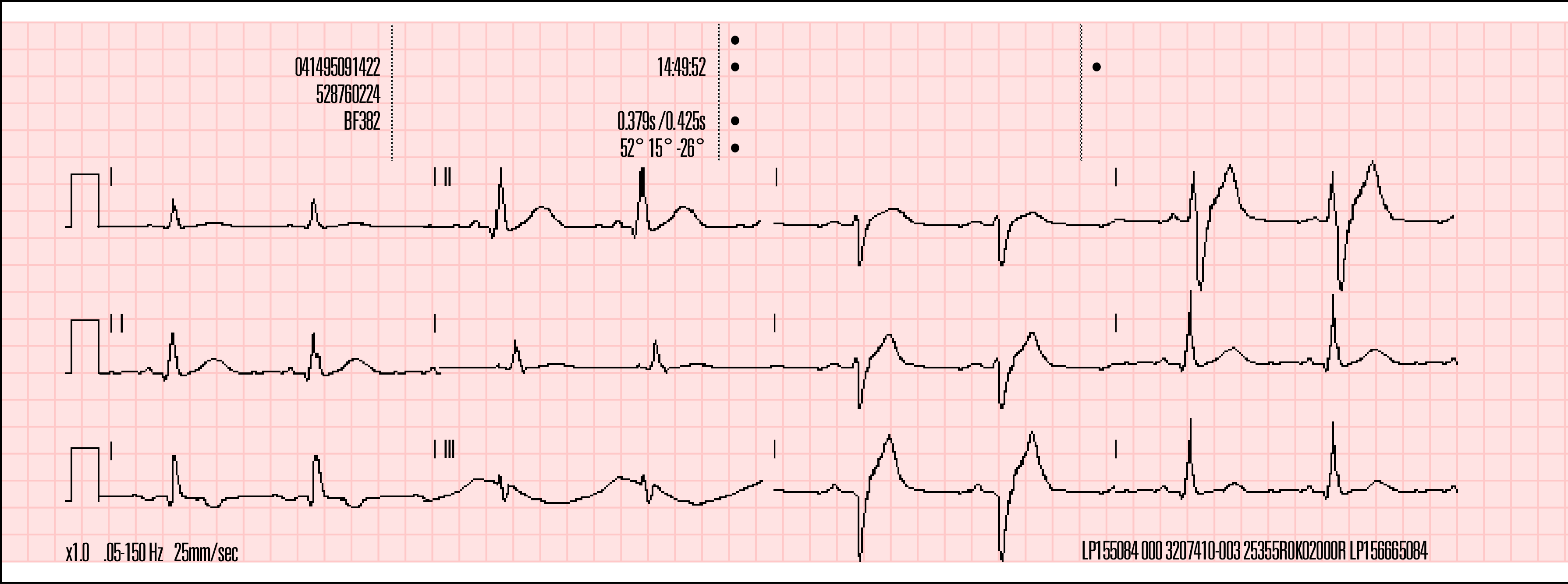 Kuva 4-8 on esimerkki 12-kytkentäisen EKG:n raportista, joka on tulostettu 3-kanavaisessa muodossa Cabrera-tyylillä.