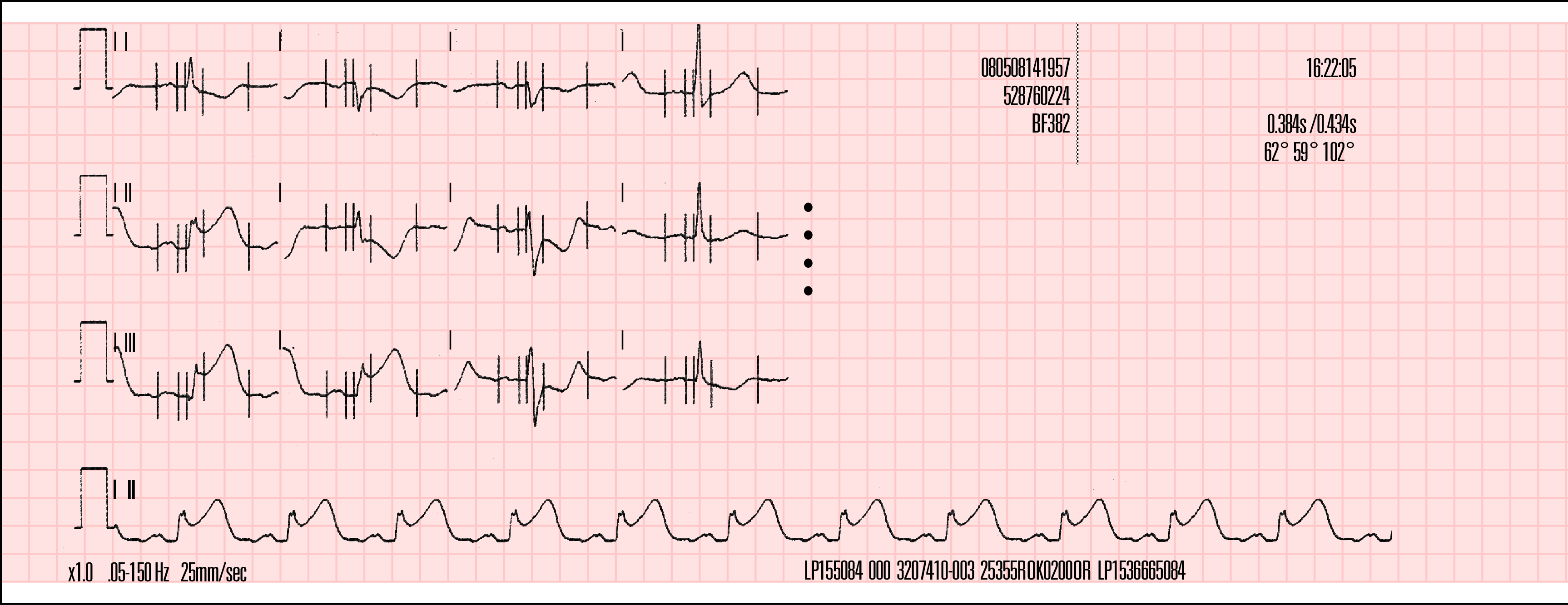 Nelikanavainen muoto Kuva 4-9 ja Kuva 4-10 ovat esimerkkejä 12-kytkentäisistä EKG-raporteista, jotka on tulostettu 4-kanavaisessa muodossa.