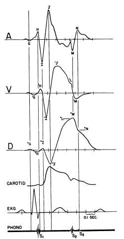 Kuva 9: Kiihtyvyyttä (A), nopeutta (V) ja siirtymää (D) kuvaavat tyypilliset ballistokardiogrammit sekä kaulavaltimopulssi (carotid),