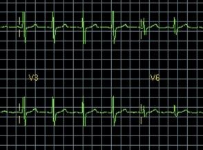 Tärkeä osa Philipsin kardiologisia ratkaisuja Philipsin kardiologisiin ratkaisuihin sisältyvät EKG-piirturit ja tietojen hallinta.