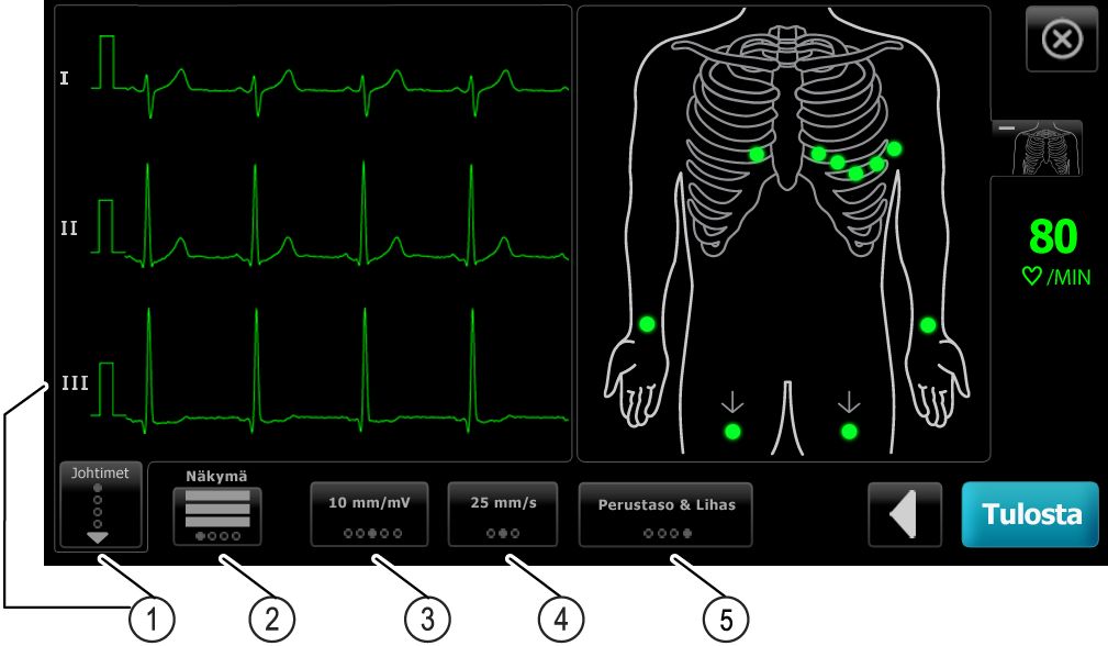 8 Automaattisen EKG-tutkimuksen suorittaminen CP 150 12-johtiminen lepopulssia mittaava elektrokardiografi Nimike Painike 1 Johtimet (Leads) -painike 2 EKG:n esikatselupainike 3 Vahvistus (Gain)