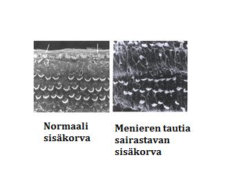 Kuulo ongelmat on osa Menieren tautia ja ne vaihtelevat taudin aktiviteetin mukaan. Yleensä kuulo heikkenee kohtauksien yhteydessä ja sen jälkeen voi parantua.