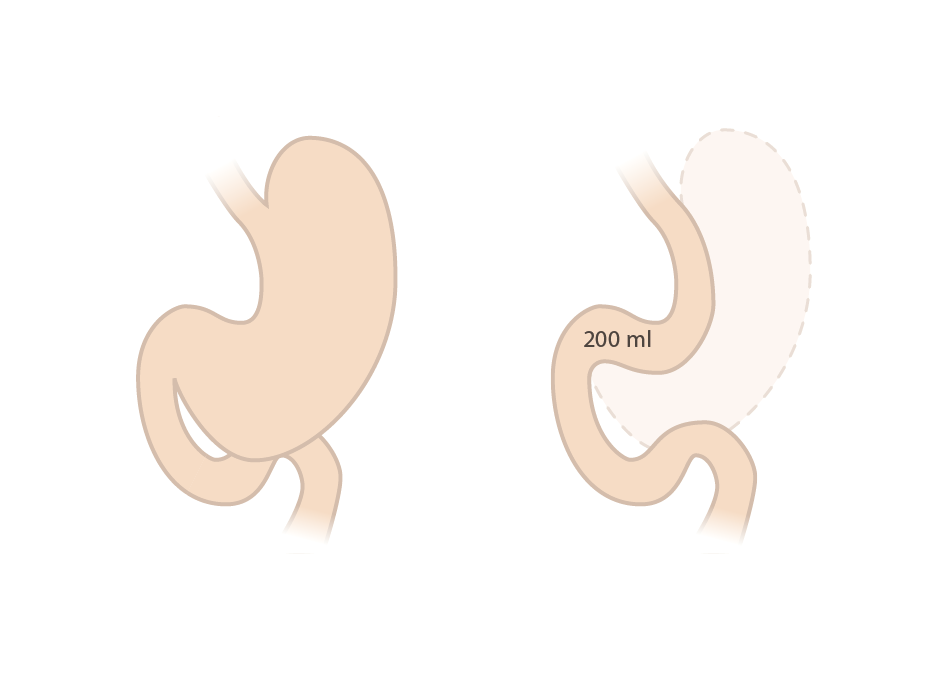 4.2. Laparoskooppinen mahalaukun vertikaalinen kavennus (laparoscopic gastric sleeve resection) Tässä leikkauksessa mahalaukun suuri kaari poistetaan (85 % mahalaukusta) ja jäljelle jäävästä