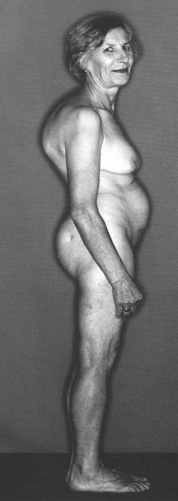 Osteoporoosin oireet OP 67-vuotiaalla liettualaisella naisella Dg 57-vuotiaana, pituus lyhentynyt 7 cm Oireettomuus