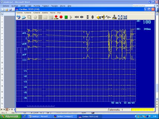 46 Tallentaa voit tästä tai käyttämällä pika näppäintä F9 Katso, että tämä keltainen palkki on täyttynyt kokonaan, muuten EKG ei tallennu. Tässä näkyy teksti, kun nauhoite on tallennettu.